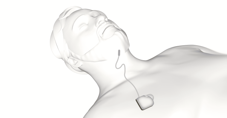 Illustration de l'article Bordeaux : La Nouvelle Clinique Bel-Air propose le pacemaker du sommeil